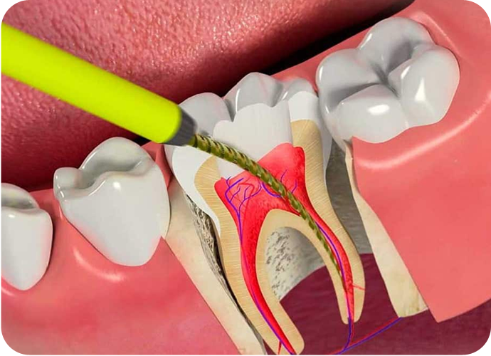 Endodontics Treatment